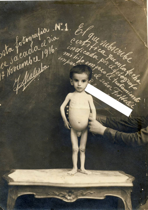 Fotografías de dos casos clínicos (1916 y 1917) de dos niños tratados con el tratamiento Frittelli